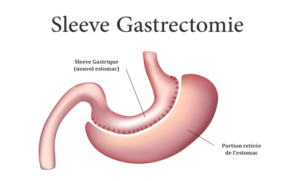 Les résultats de la sleeve gastrectomie : perte de poids, amélioration de la santé et qualité de vie