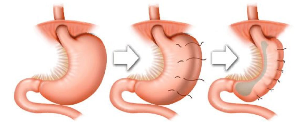 Sleeve Endoscopique