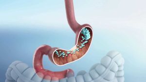 Gastroplastie endoscopique traitement obésité : la révolution