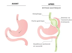 Solution contre l'obésité le bypass gastrique