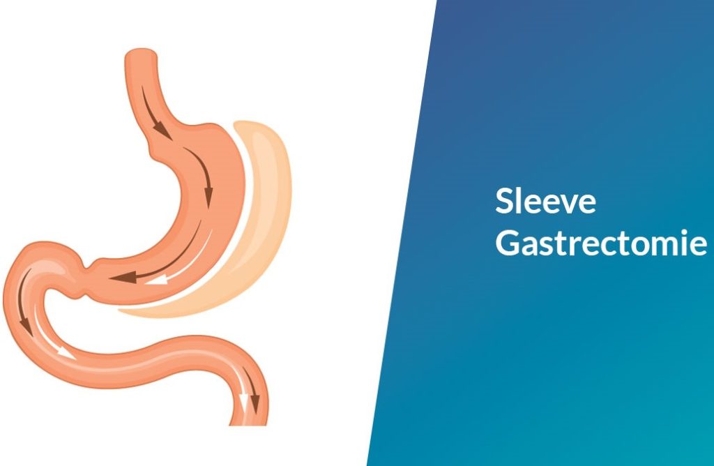 Interventions bariatriques sleeve gastrectomie face aux autres