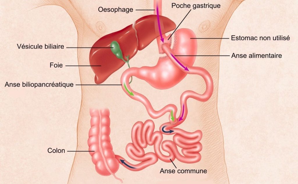 Bypass gastrique la réalité : L’outil, c’est vous !