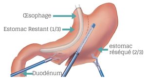 La chirurgie un regard approfondi : Sleeve gastrectomie