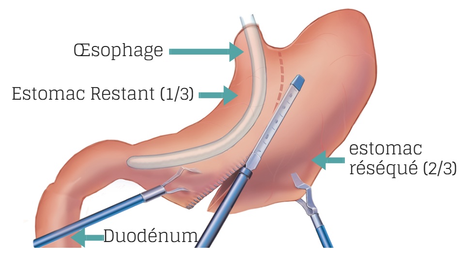 La chirurgie un regard approfondi : Sleeve gastrectomie