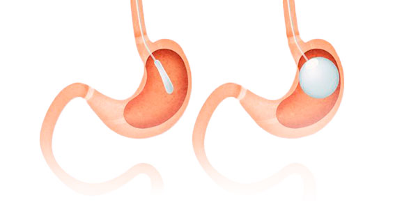 Le ballon gastrique ajustable : une solution sur mesure pour optimiser les résultats