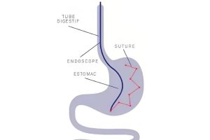 Sleeve endoscopique et médicaments contre l'obésité : une association prometteuse pour optimiser la perte de poids