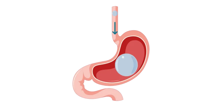 Le ballon gastrique comme outil de prévention des comorbidités liées à l'obésité : focus sur le diabète de type 2 et les maladies cardiovasculaires